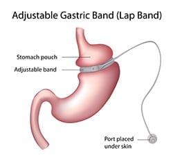 Gastric-Band-Surgery-The-Lap-Band-Center-4