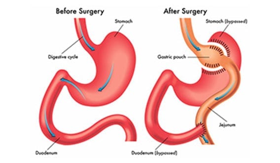 Gastric-Bypass-The-Lap-Band-Center-1