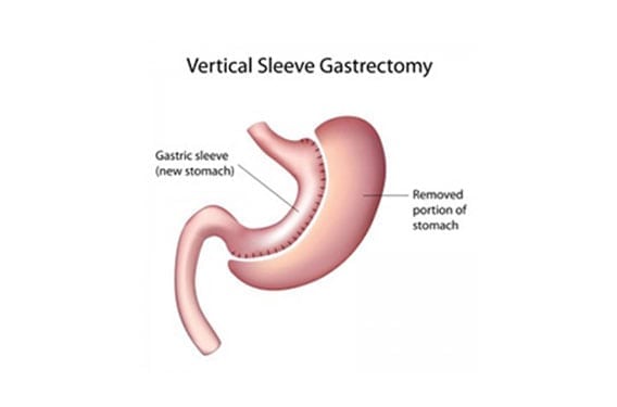 Gastric-Sleeve-The-Lap-Band-Center-1