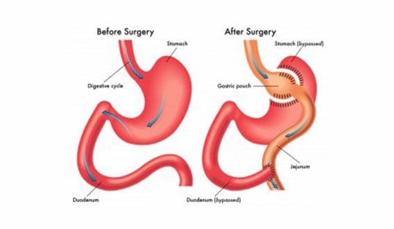 Gastric-Surgery-The-Lap-Band-Center-1