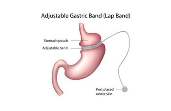 Revision-Bariatric-Surgery-The-Lap-Band-Center-1