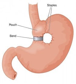 Revision Bariatric Surgery - The Lap-Band Center 3
