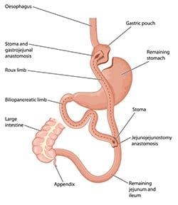 Roux-en-Y-Gastric-Bypass-The-Lap-Band-Center-2