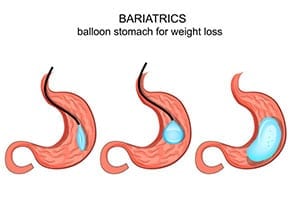 Stomach-Balloon-The-Lap-Band-Center-3