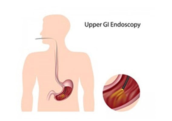Stomach-Endoscopy-The-Lap-Band-Center-1