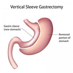 Vertical Sleeve Gastrectomy - The Lap-Band Center 4