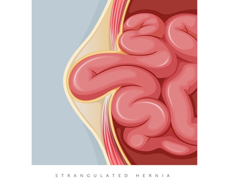 Digital-illustration-of-a-hernia