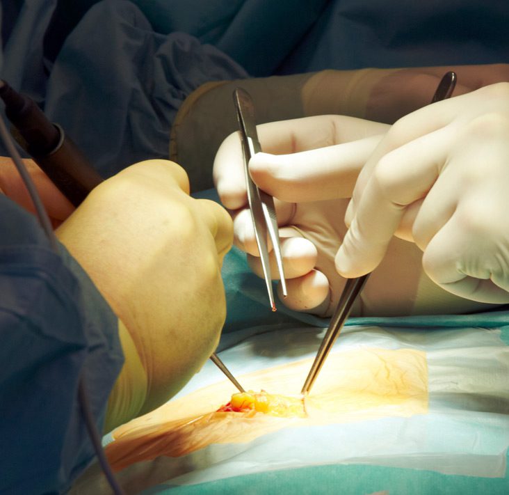 Surgeons-performing-hernia-repair
